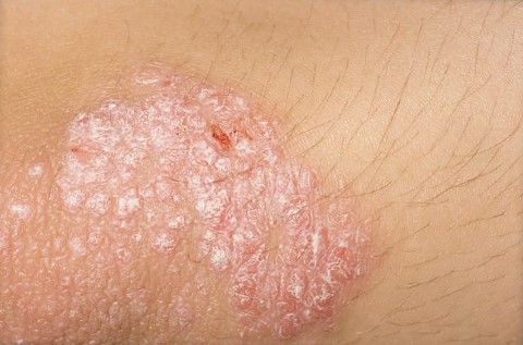 Psoriasis