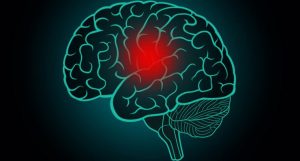 Gejala stroke