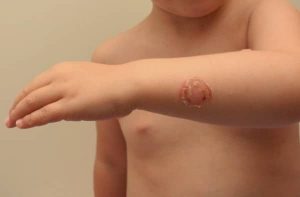 Impetigo liver adalah