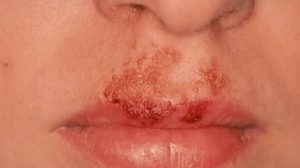 apa itu Penyakit Impetigo