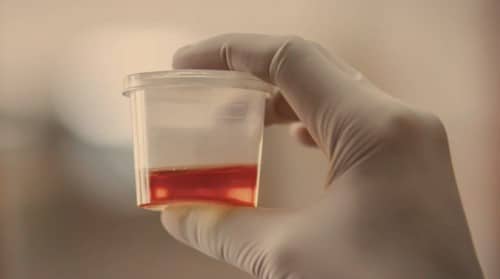 Hematuria (Kencing Darah)