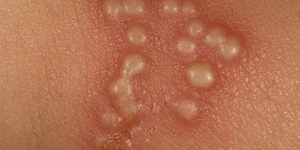 Ciri ciri penyakit herpes simplex genitalis