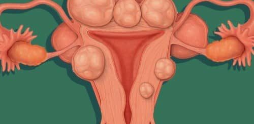 Mioma uteri