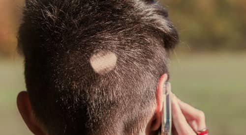 Alopecia areata