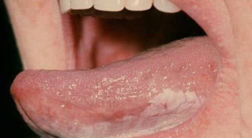 Leukoplakia