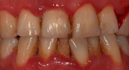 Periodontitis