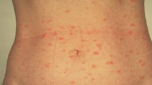 Pityriasis Rosea Gibert