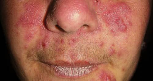 Rosacea