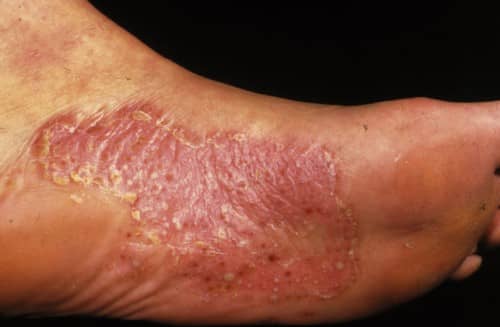 Tinea Pedis