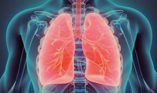 Acute respiratory distress syndrome