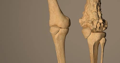 Osteosarcoma