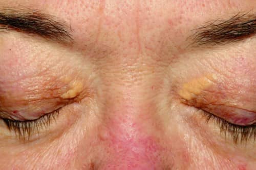 Xanthelasma