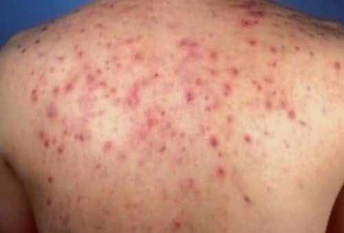 Hidradenitis Suppurativa