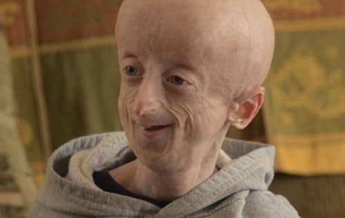 Penyebab progeria