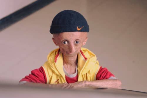 Progeria