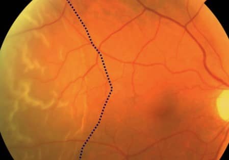 Gejala ablasio retina