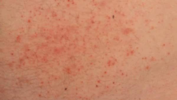 Gejala dermatitis herpetiformis