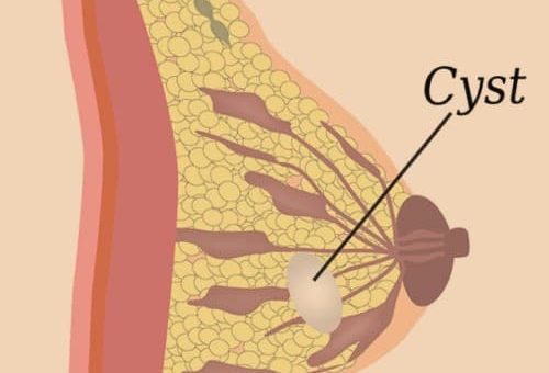 Penyebab kista payudara