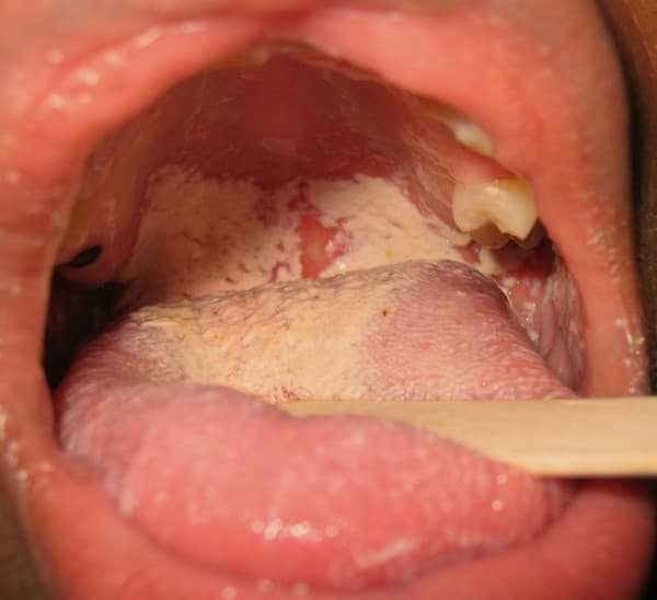 Gejala oral candidiasis