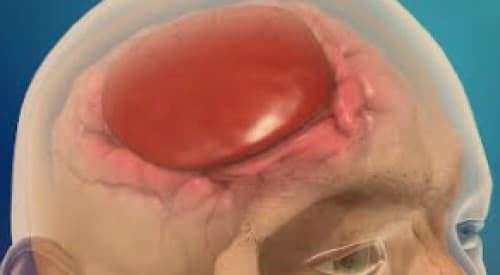 Hematoma subdural