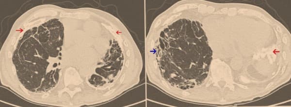 Penyebab asbestosis