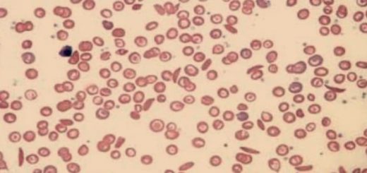 Gejala anemia sel sabit