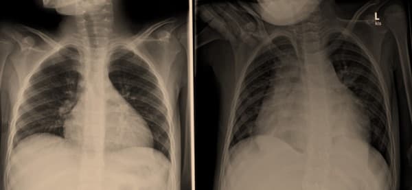 Gejala cardiac tamponade