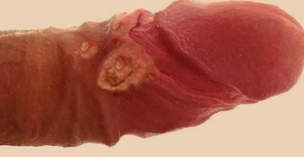 Lymphogranuloma Venereum