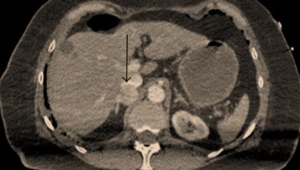 Feokromositoma