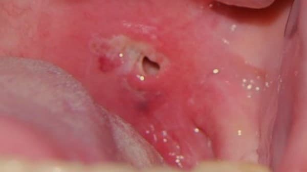 Peritonsil abscess