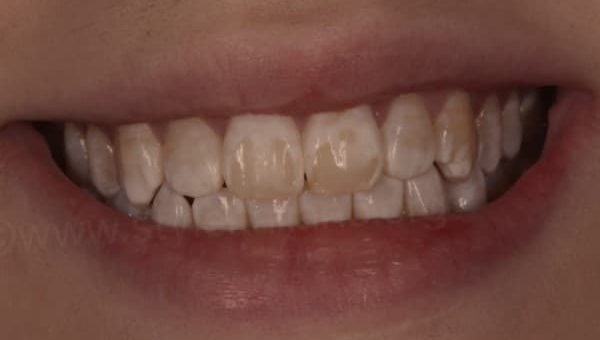 Fluorosis