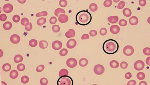 Paroksismal Nokturnal Hemoglobinuria