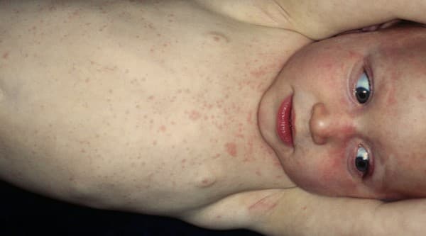 Roseola