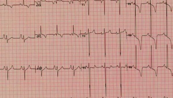 Elektrokardiogram