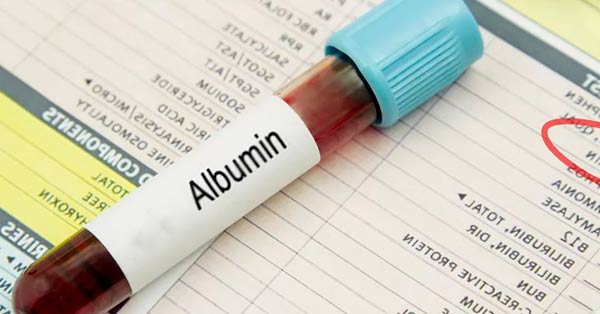Analisa Albumin