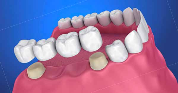 Crowns Restore damaged teeth