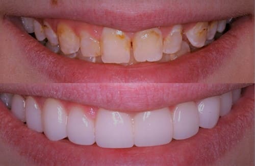 Veneer Gigi