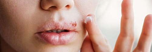 salep herpes adalah