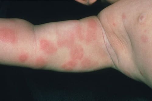 merawat alergi kulit 