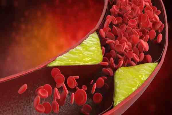 Hiperlipidemia adalah