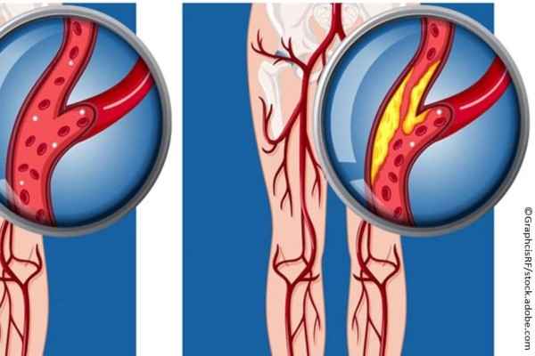 Penyakit Arteri Peripheral 